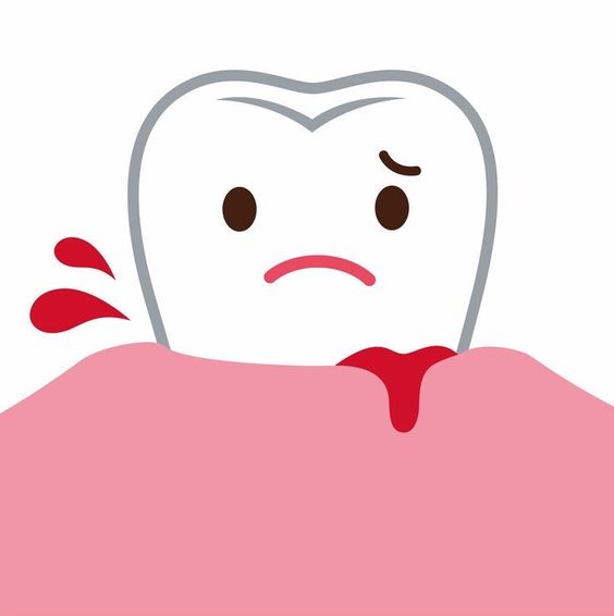 Gingivitis: Symptoms and How To Treat It